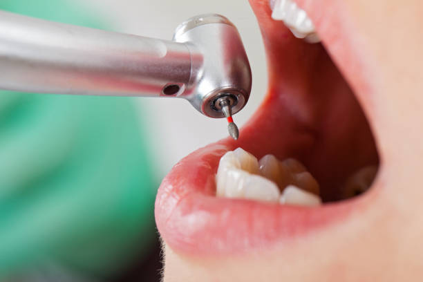 Emergency Dental Filling Replacement in MS